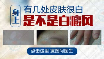 孩子得了白癜风该怎么治疗呢