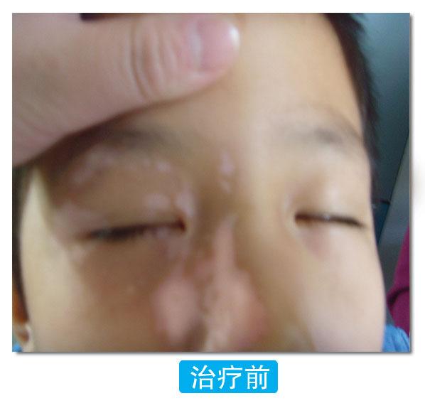 308nm准分子激光可以治疗青少年白癜风吗