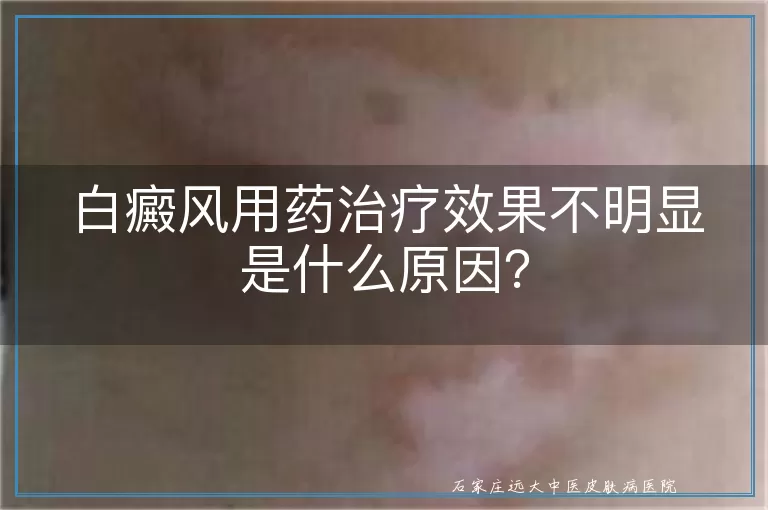 白癜风用药治疗效果不明显是什么原因？