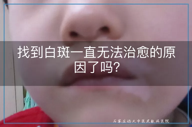 找到白斑一直无法治愈的原因了吗？