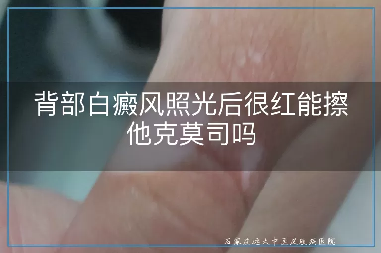 背部白癜风照光后很红能擦他克莫司吗