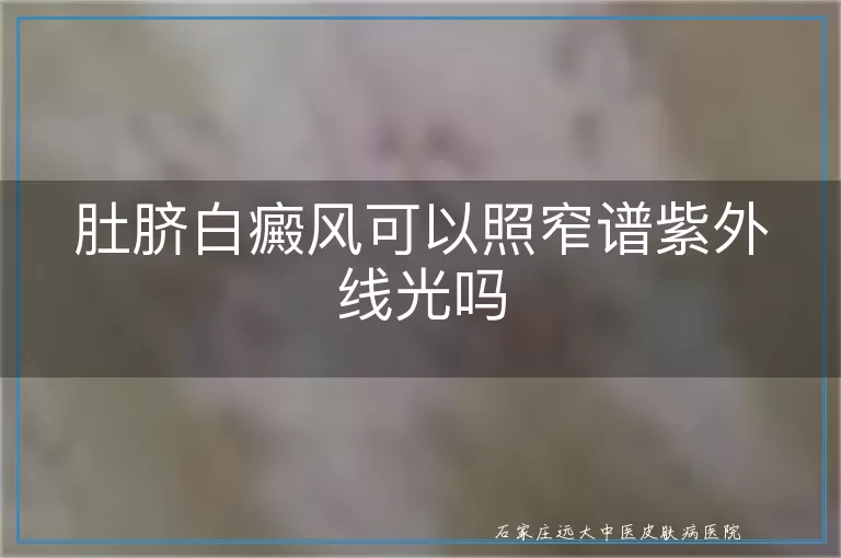 肚脐白癜风可以照窄谱紫外线光吗