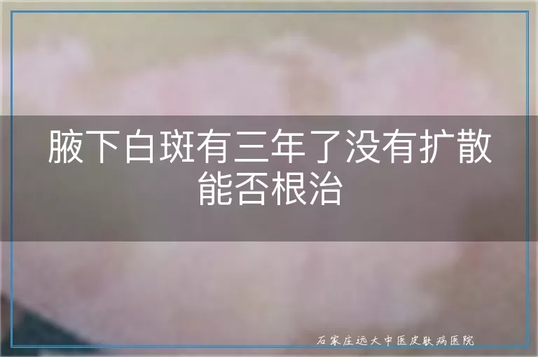 腋下白斑有三年了没有扩散能否根治