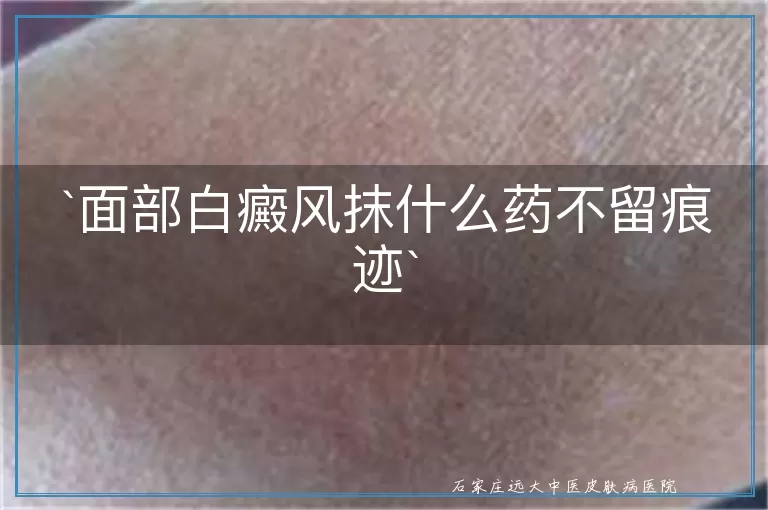 `面部白癜风抹什么药不留痕迹`