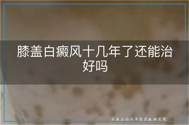 膝盖白癜风十几年了还能治好吗