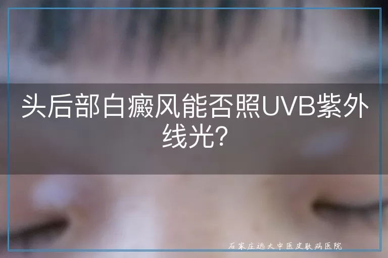 头后部白癜风能否照UVB紫外线光？