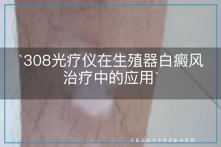 `308光疗仪在生殖器白癜风治疗中的应用`