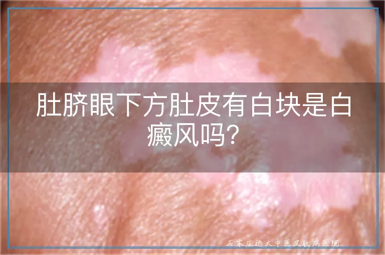 肚脐眼下方肚皮有白块是白癜风吗？