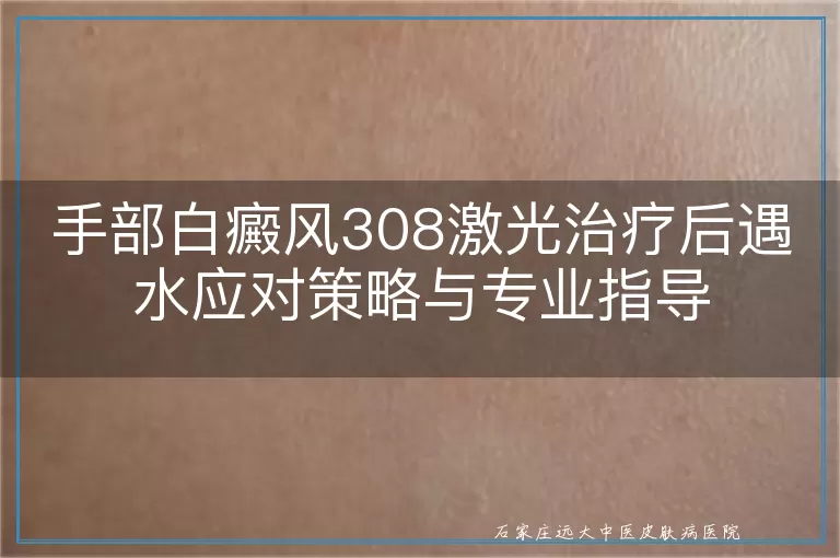 手部白癜风308激光治疗后遇水应对策略与专业指导