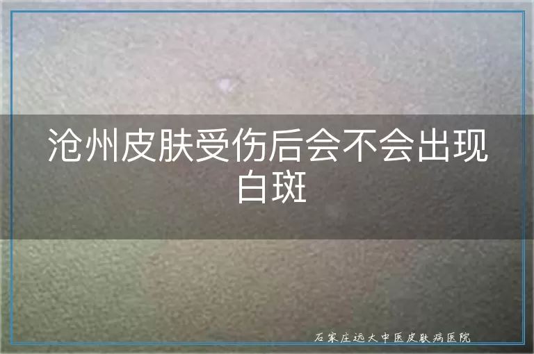 沧州皮肤受伤后会不会出现白斑