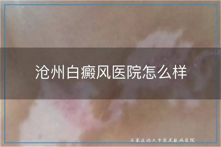 沧州白癜风医院怎么样