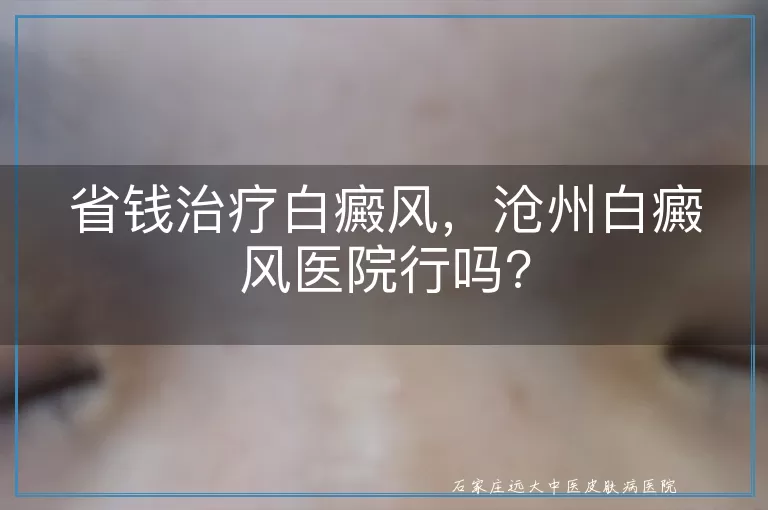 省钱治疗白癜风，沧州白癜风医院行吗?