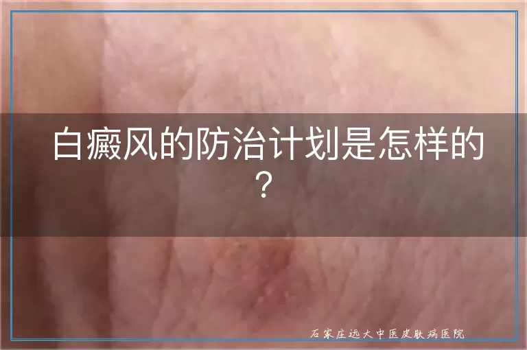 白癜风的防治计划是怎样的？