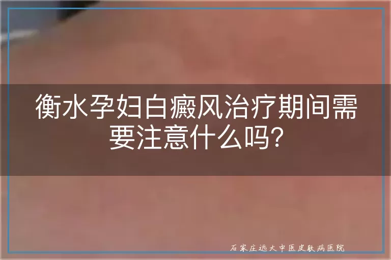 衡水孕妇白癜风治疗期间需要注意什么吗？