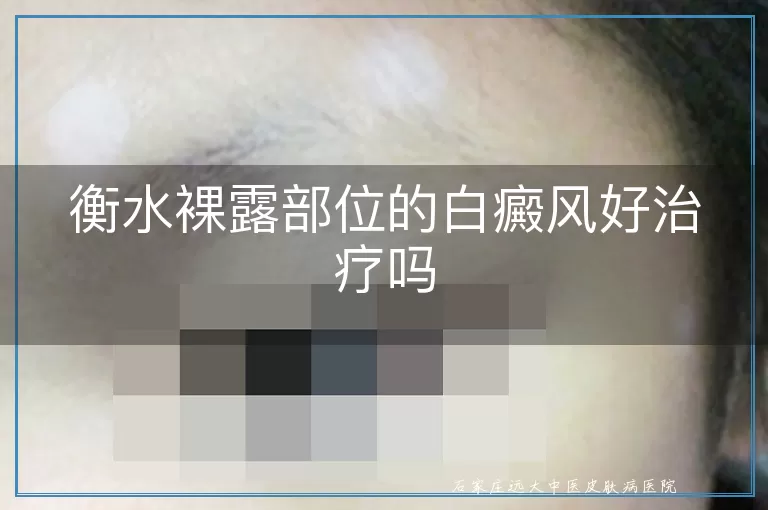 衡水裸露部位的白癜风好治疗吗