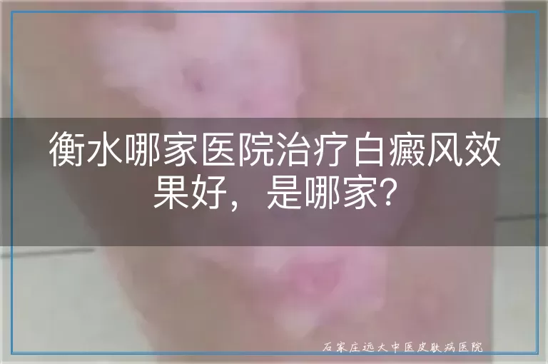 衡水哪家医院治疗白癜风效果好，是哪家？