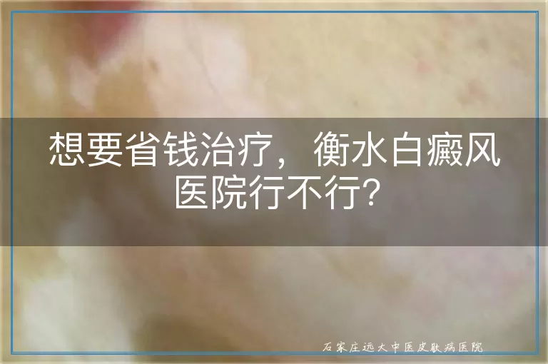 想要省钱治疗，衡水白癜风医院行不行?