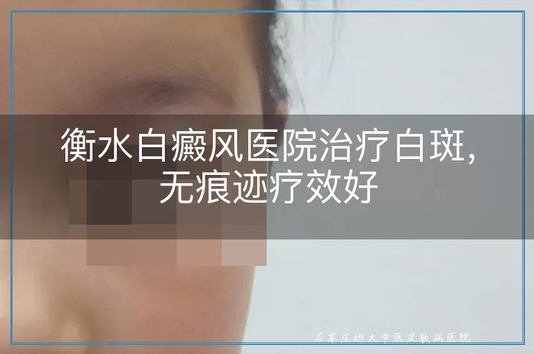 衡水白癜风医院治疗白斑，无痕迹疗效好