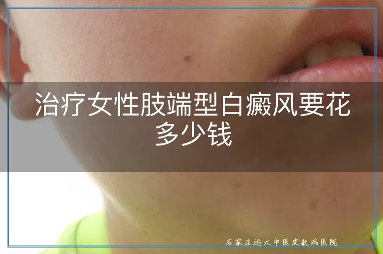 治疗女性肢端型白癜风要花多少钱