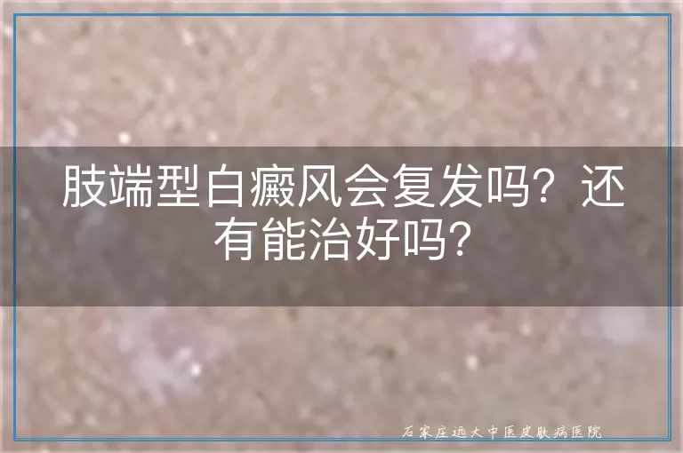 肢端型白癜风会复发吗？还有能治好吗？