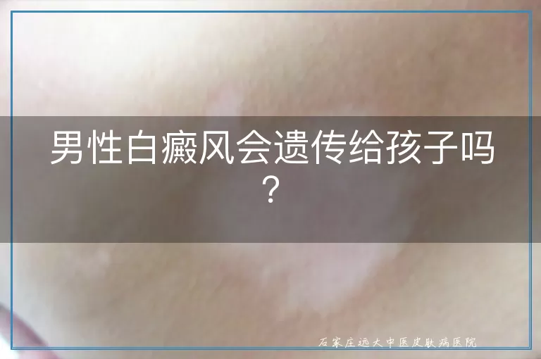 男性白癜风会遗传给孩子吗？