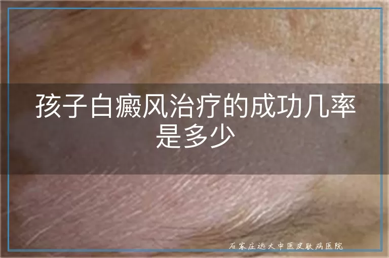 孩子白癜风治疗的成功几率是多少