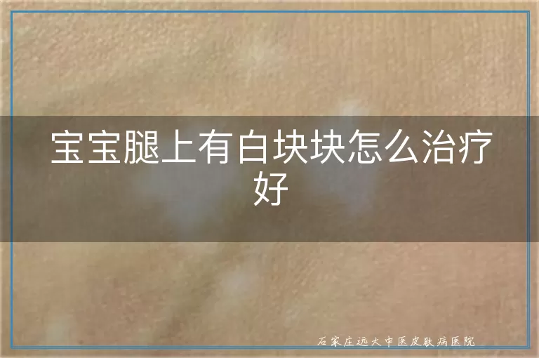 宝宝腿上有白块块怎么治疗好