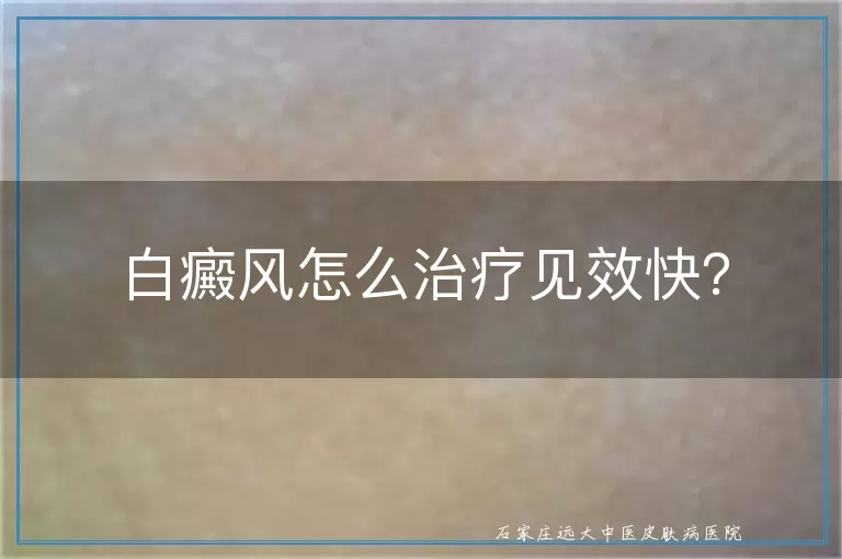 白癜风怎么治疗见效快？