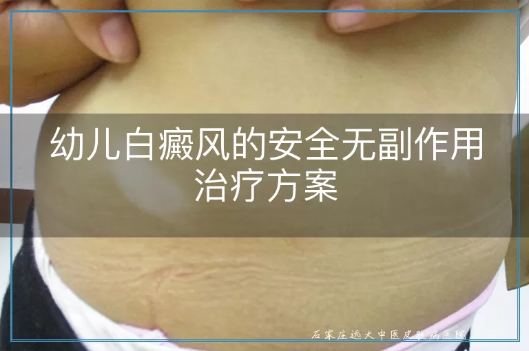 幼儿白癜风的安全无副作用治疗方案