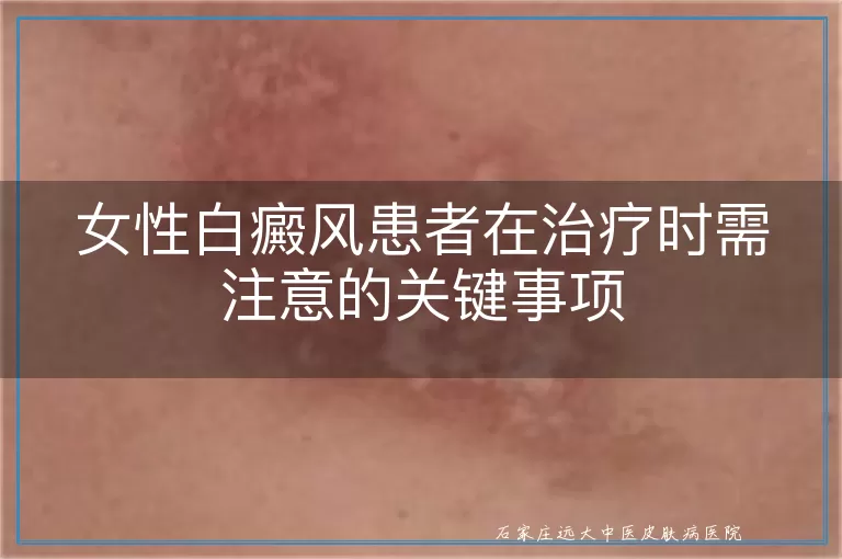 女性白癜风患者在治疗时需注意的关键事项