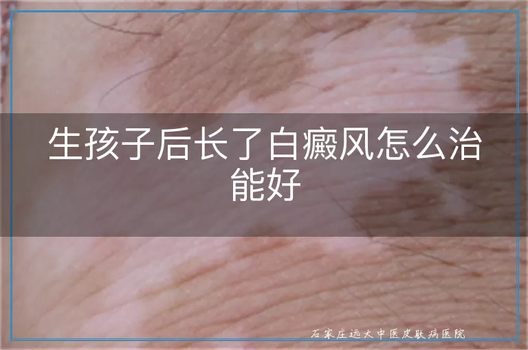 生孩子后长了白癜风怎么治能好