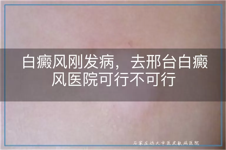 白癜风刚发病，去邢台白癜风医院可行不可行