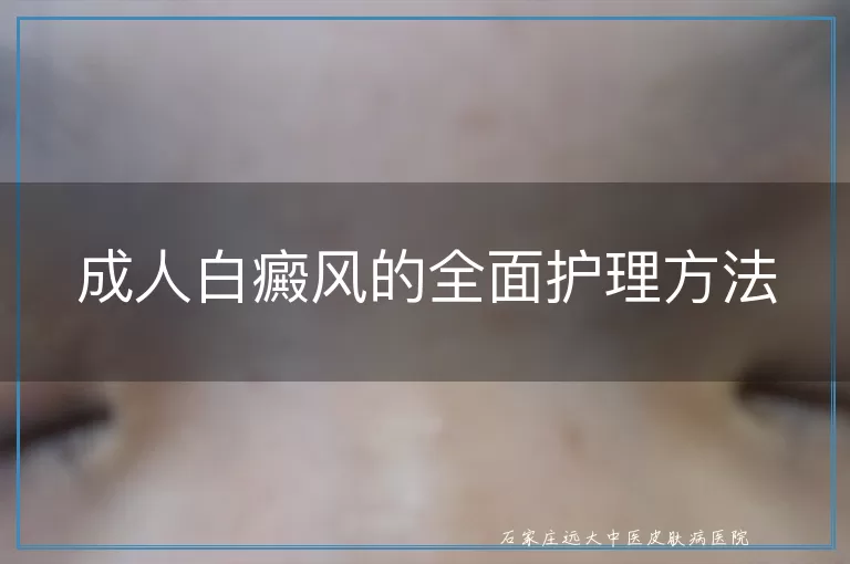 成人白癜风的全面护理方法