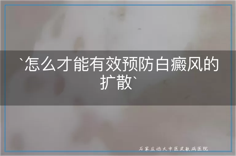 `怎么才能有效预防白癜风的扩散`