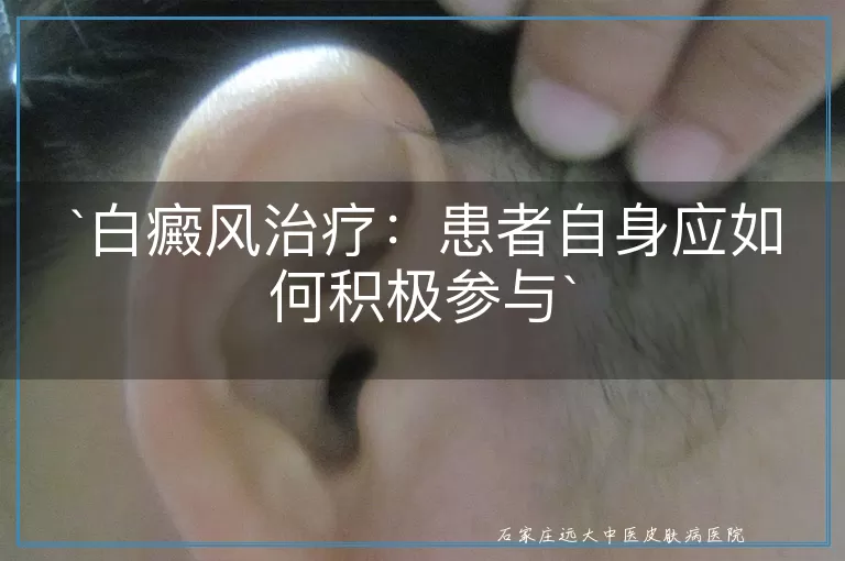 `白癜风治疗：患者自身应如何积极参与`