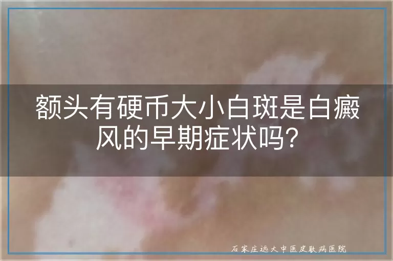 额头有硬币大小白斑是白癜风的早期症状吗？