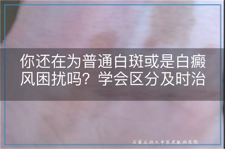 你还在为普通白斑或是白癜风困扰吗？学会区分及时治疗！