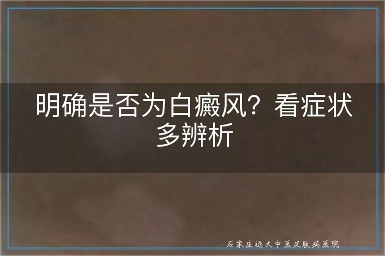 明确是否为白癜风？看症状多辨析