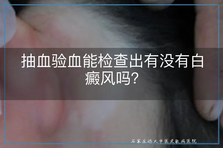 抽血验血能检查出有没有白癜风吗？