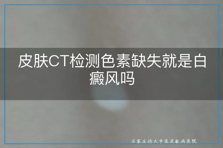 皮肤CT检测色素缺失就是白癜风吗