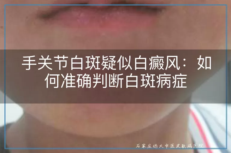 手关节白斑疑似白癜风：如何准确判断白斑病症