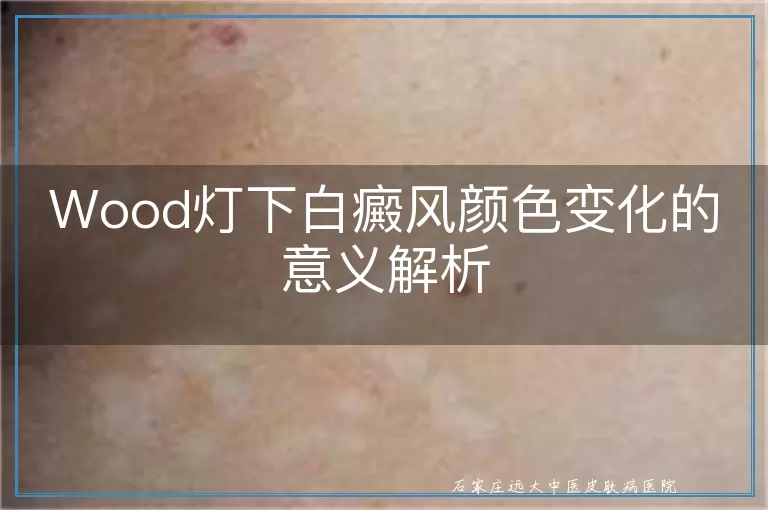 Wood灯下白癜风颜色变化的意义解析