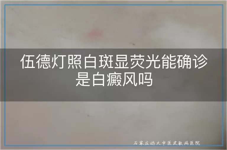 伍德灯照白斑显荧光能确诊是白癜风吗