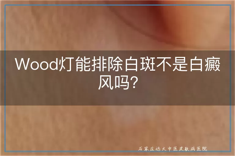 Wood灯能排除白斑不是白癜风吗？