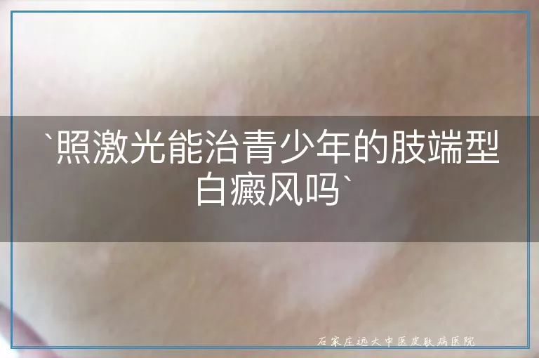 `照激光能治青少年的肢端型白癜风吗`