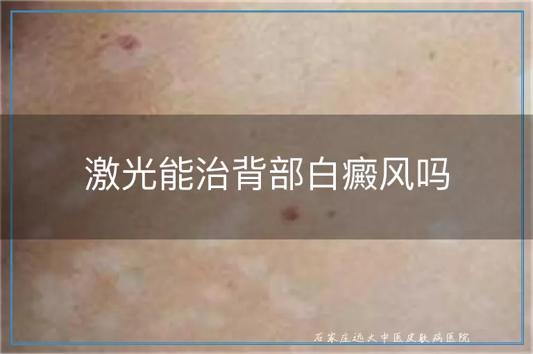 激光能治背部白癜风吗