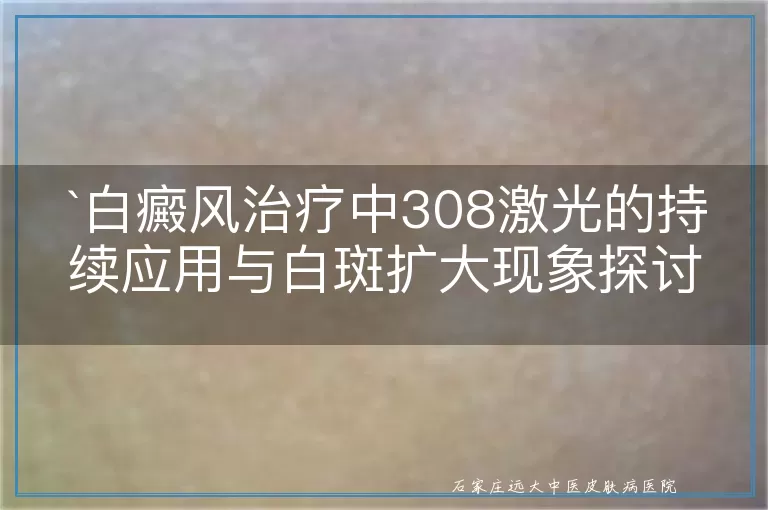 `白癜风治疗中308激光的持续应用与白斑扩大现象探讨`