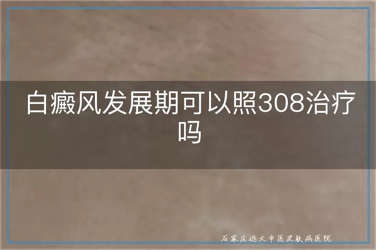 白癜风发展期可以照308治疗吗