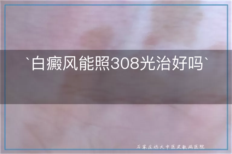 `白癜风能照308光治好吗`