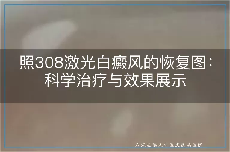 照308激光白癜风的恢复图：科学治疗与效果展示